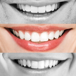 Die häufigsten Irrtümer über Zahnersatz von heute